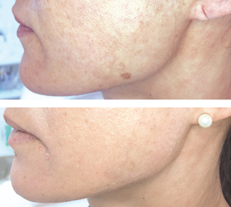 Removal of Pigment Spots